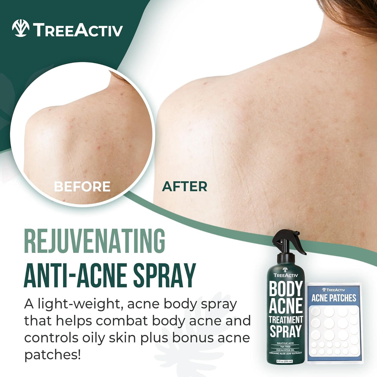8 fl oz 2% Salicylic Acid Body Acne Treatment Spray E204