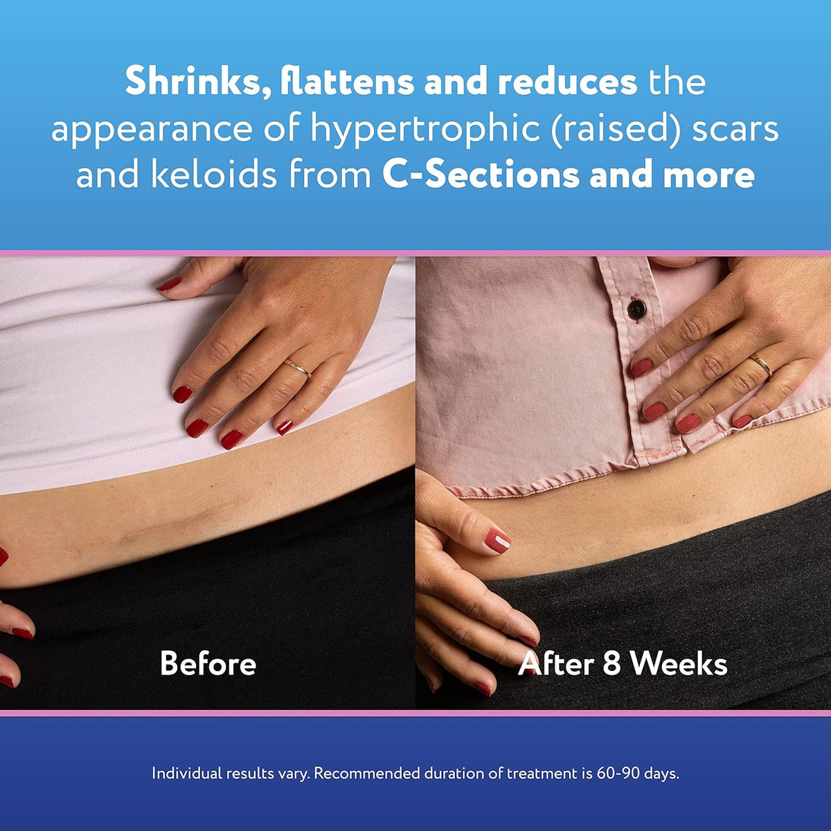 Reusable Silicone Scar Sheets (1.5” x 7”), 4 Sheets J60931